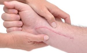 Factores que afectan a la cicatrizacion